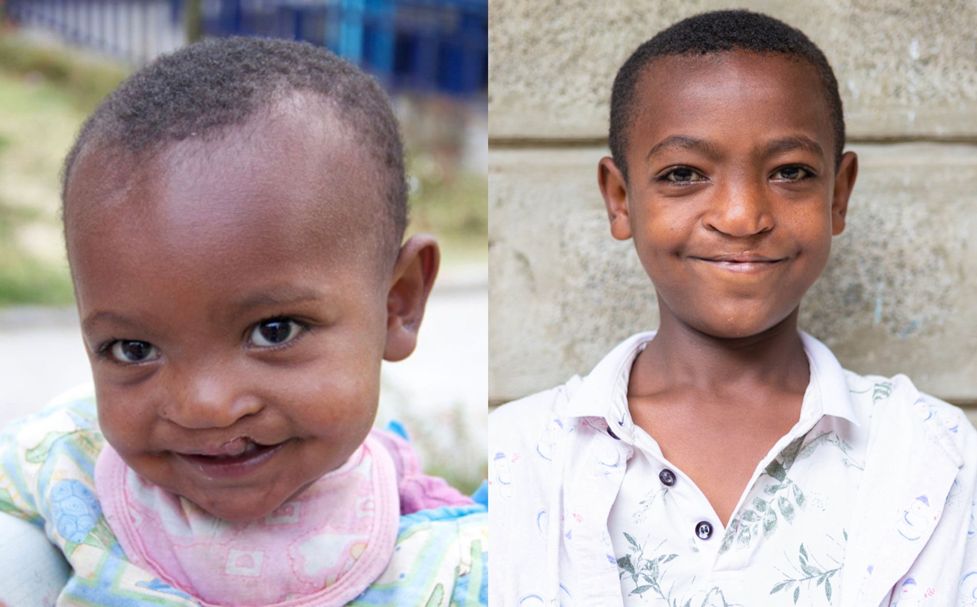 child with cleft lip, before and after